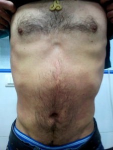 psoriasis tronco 3 semanas después de tratamiento conn artemisia annua